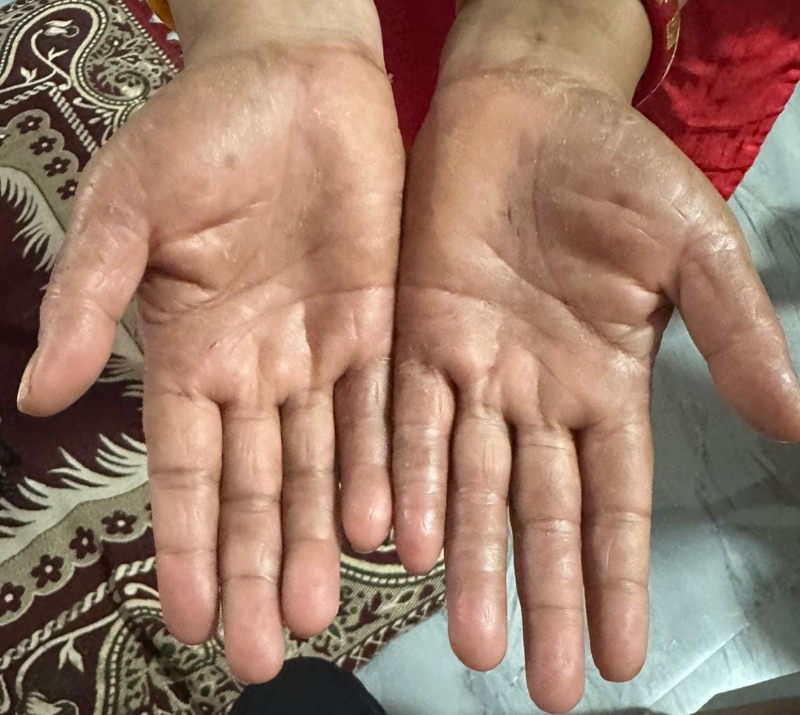 Another health crisis in Buldhana